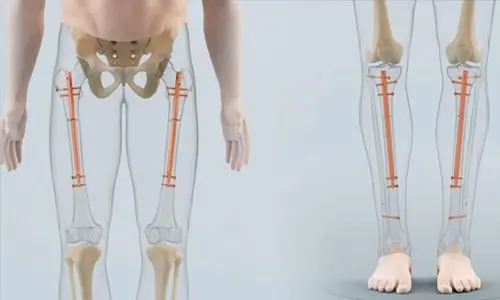 boy uzatma ameliyati