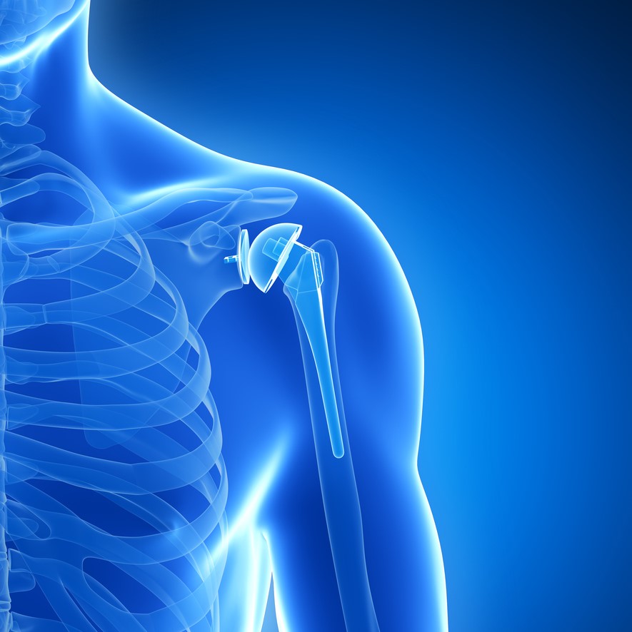 omuz protezi 2 2703 3062