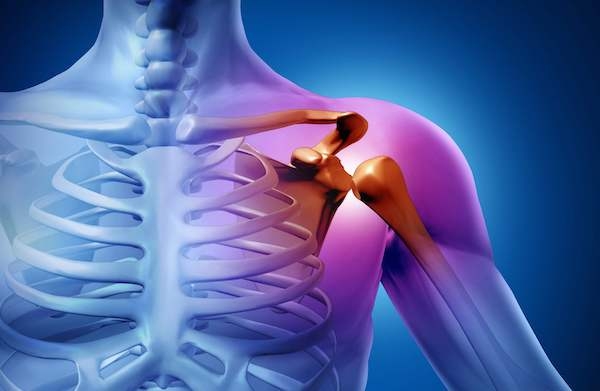 omuz sikisma sendromu