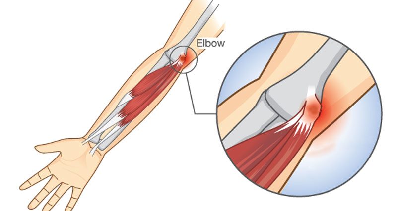 golfers elbow800 1 800x426 1