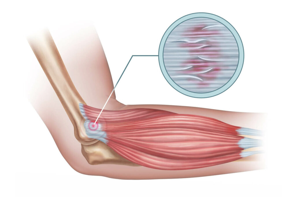 tenisci dirsegi model 1024x683 1